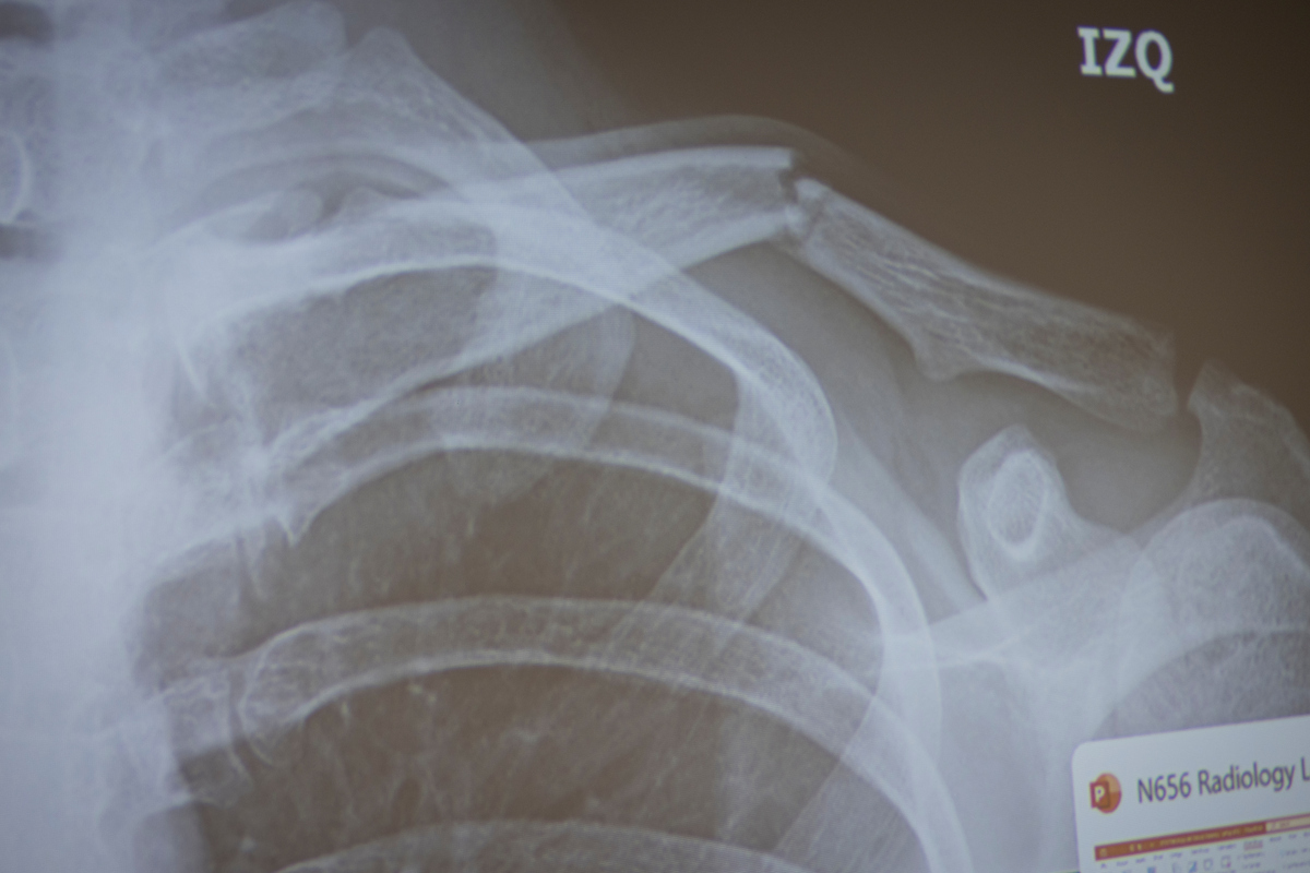 X-ray image of a broken shoulder.